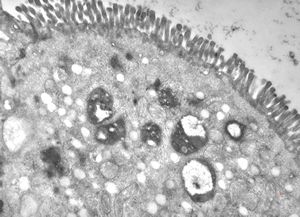 celiakia celiakia